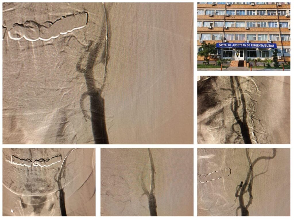 Premieră medicală în radiologie intervențională la SJU Buzău