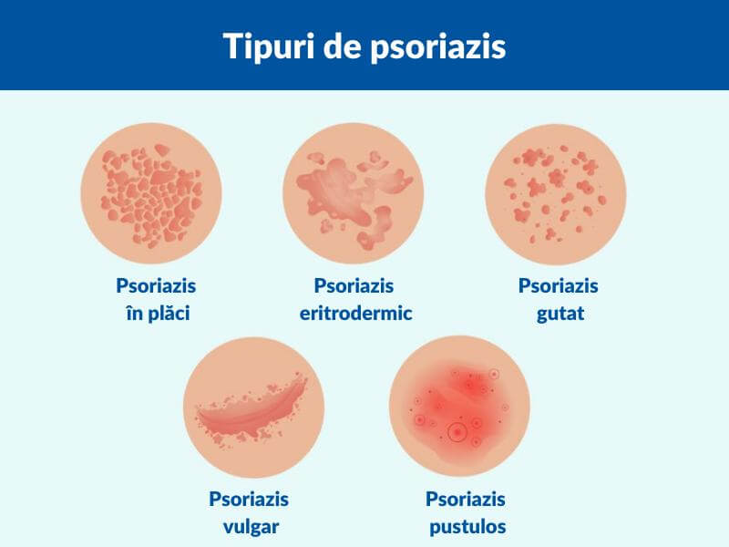 Psoriazis: cauze, forme de boală, diagnostic și tratament | Interviu cu Dr. Adina Pavel, medic specialist Dermato-venerologie în cadrul S.J.U. Buzău